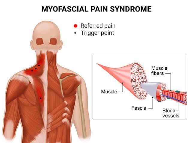 Diagram of myofascial pain syndrome showing muscle fibers, fascia, blood vessels, and trigger points. The image highlights areas of referred pain and how trigger points affect surrounding muscle and connective tissue
