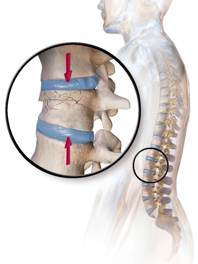 compression fracture vertebra treatment years later bpc 157 Compression Fractures Treatment at Prestige Health & Wellness