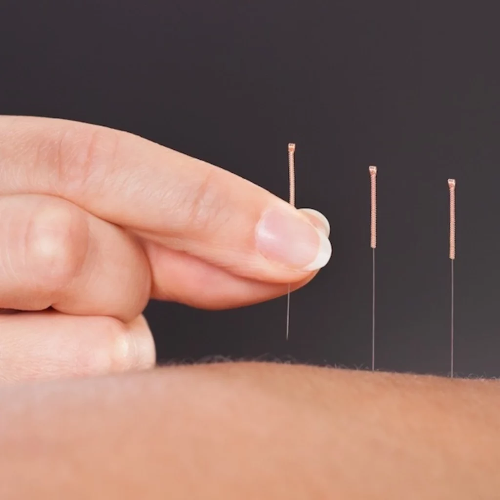 Acupuncture treatment at a Manhattan chiropractic clinic, NYC