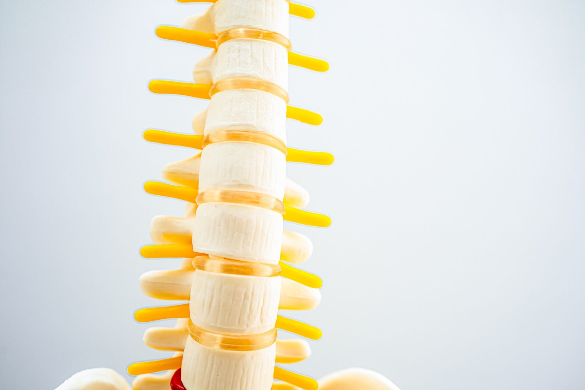 Lumbar spine model showing a herniated disc