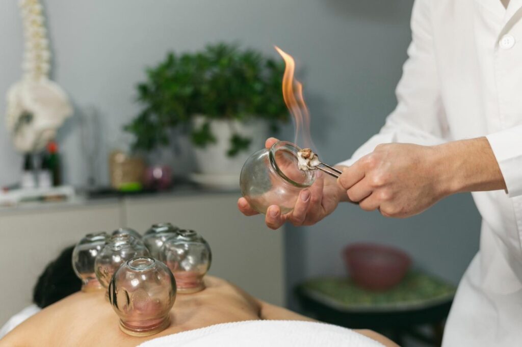 Therapist performing fire cupping therapy by heating a glass cup with a flame before applying it to a patient's back, where multiple cups are already in place, creating suction for muscle tension relief.