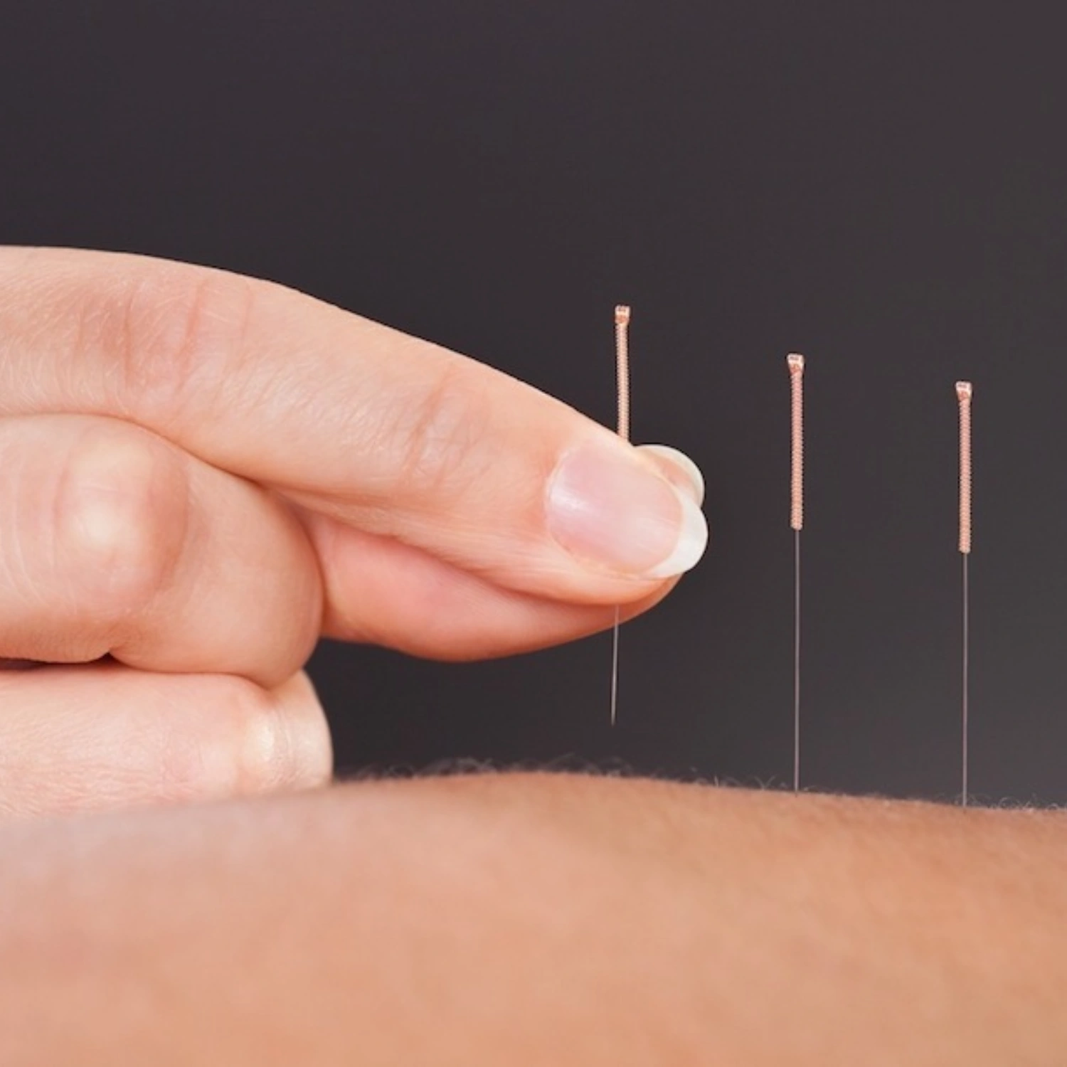 Acupuncture treatment at a Manhattan chiropractic clinic, NYC