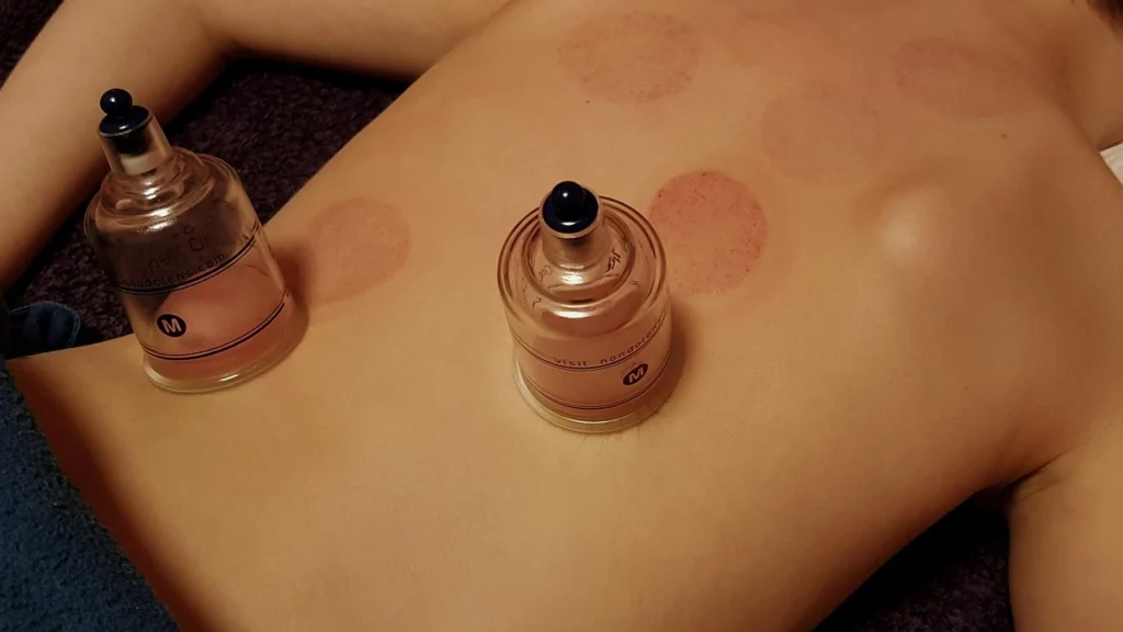 Cupping therapy marks - red circular spots on skin after cupping treatment, showing improved blood flow and muscle recovery