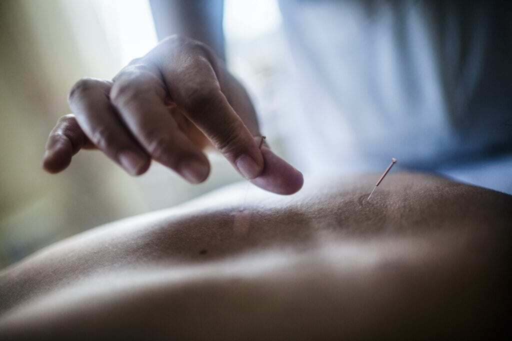 Acupuncture needle placed on a patient’s back during treatment
