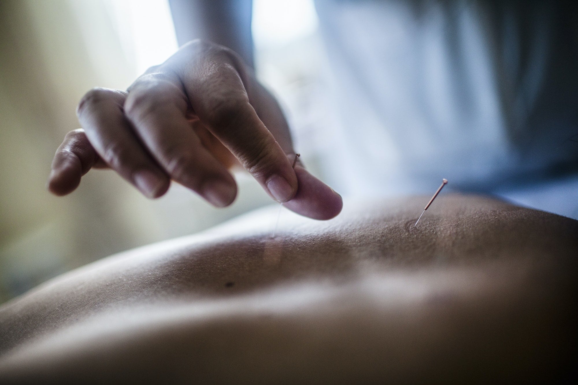 How Acupuncture Works for Pain Relief