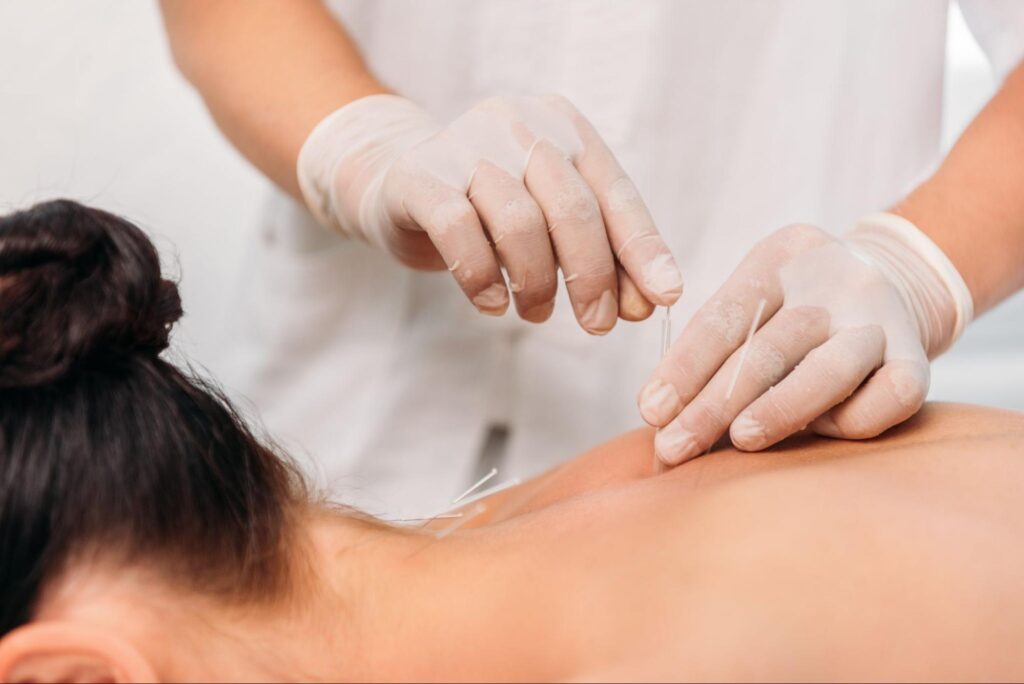 A close-up of a healthcare professional wearing gloves performing dry needling therapy by inserting thin needles into a woman’s upper back and shoulder area, targeting muscle trigger points