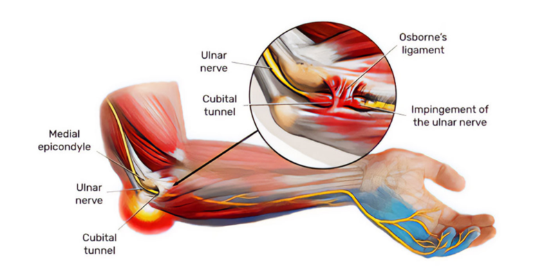 Ulnar nerve entrapment diagram showing cubital tunnel syndrome anatomy at NYC physical therapy - detailed medical illustration of elbow compression and hand numbness patterns