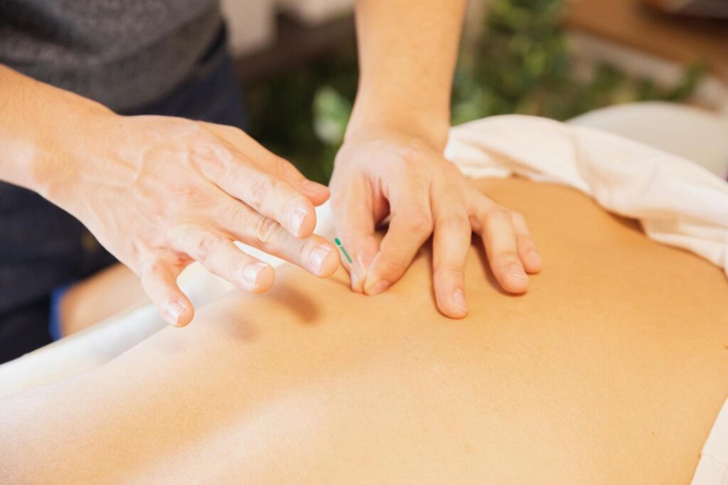 Photo showing close-up of acupuncture needles being inserted into the back of a person lying face down on a massage table. One hand is pressing the needle in, while the other hand is positioned nearby to assist. The person receiving acupuncture has bare skin exposed on their back. The background is softly blurred, focusing on the hands and needles.